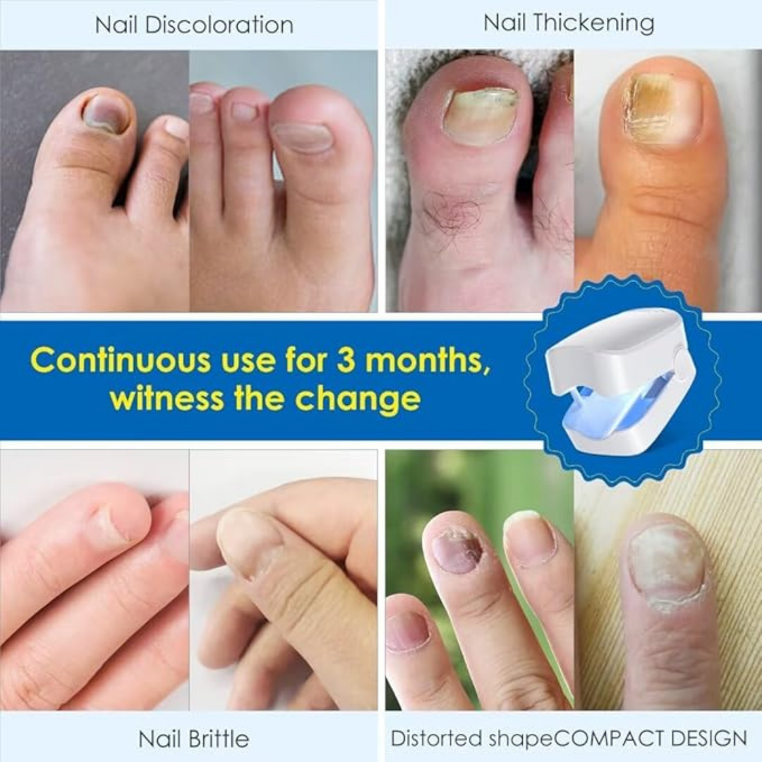 Nail Fungus Cleaning Light Device